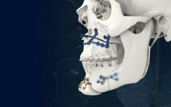 Vue latérale d'un crâne avec des implants chirurgicaux imprimés en 3D