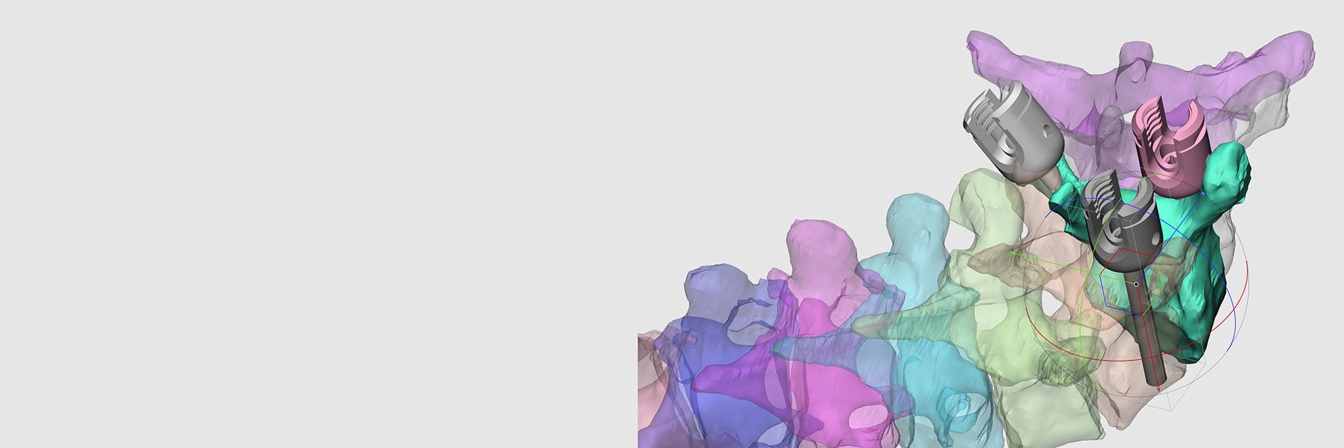 Digital, segmented model of a patient's spine with implants