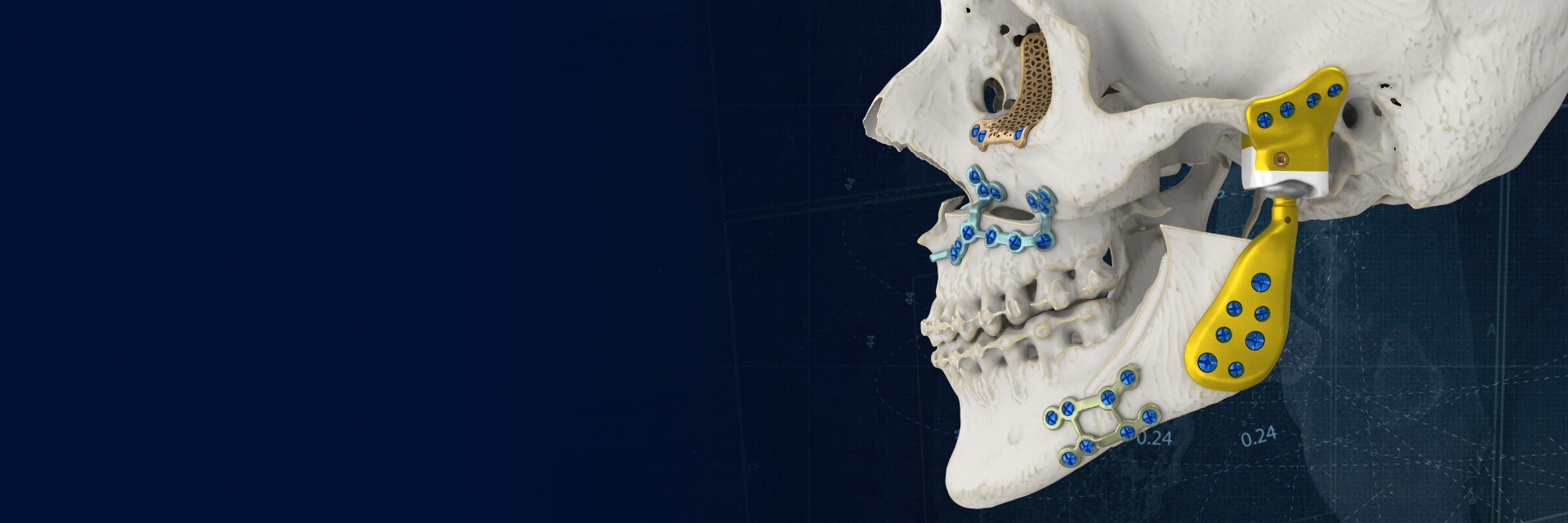 Ein Schädelmodell mit verschiedenen personalisierten, 3D-gedruckten Implantaten rund um den Kiefer und die Augenhöhle