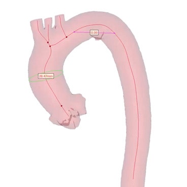 How to Analyze the Centerline of the Aorta with Materialise Mimics Core