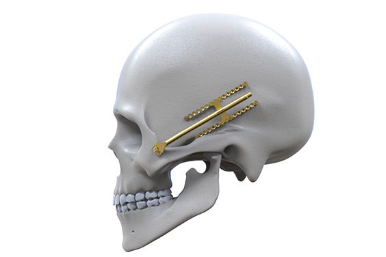 Skull model with a CMF implant on its side