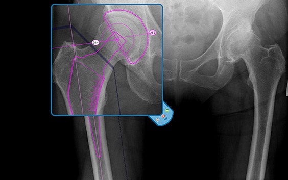 Screenshot image of hip joint templating tool on OrthoView 