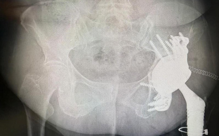 Post-operative X-ray image of the patient's pelvic area with the aMace implant