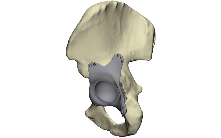 Digital image of a personalized implant on a hip bone