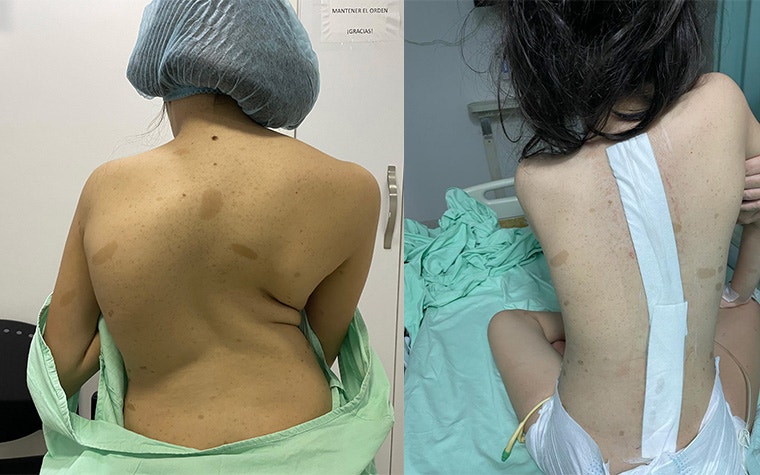 Side-by-side images of the patient before and after spinal surgery