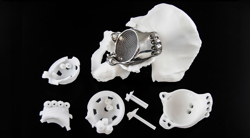 3D-printed implant in a hip model next to 3D-printed surgical guides