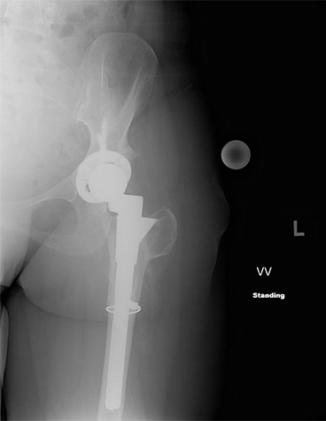 Patient’s postoperative X-ray  