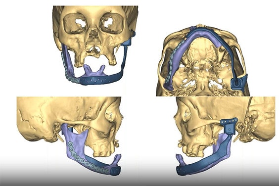 Preoperative virtual plan models, showing a personalized implant on a patient's mandible.