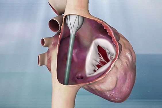 ird-valve-replacement.jpg