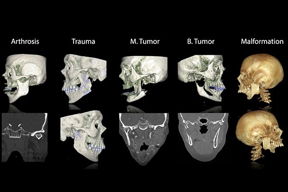 An illustration depicting various TMJ pathologies, including arthrosis, malformation, trauma, M. tumor, and B. tumor, on scans of skulls