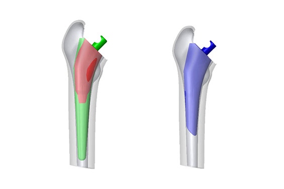 Digitaler Vergleich zwischen Originaldesign und neu gestaltetem Implantat.
