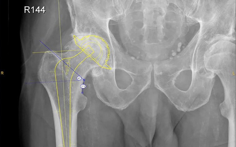Screenshot X-ray image of human pelvis with measurements on hip joint and OrthoView menu 