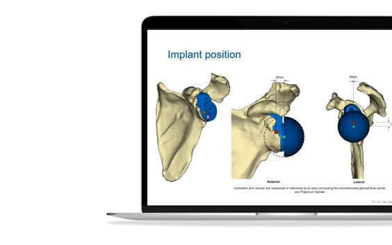 ssm-glenius-shoulder-implant-position-models.jpg
