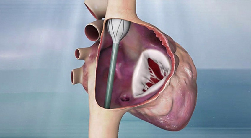 Digital image of a valve replacement