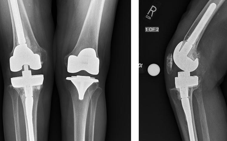 X-ray of the patient's knees with implants