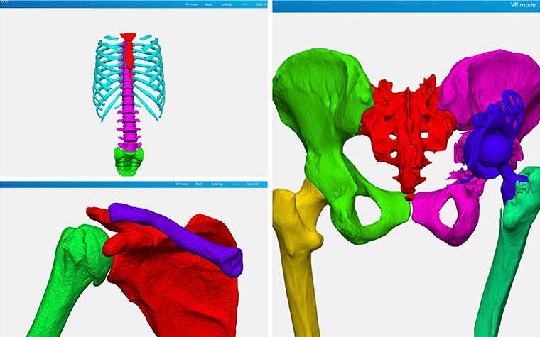 Three digital images of chest, shoulder, and pelvis bone anatomy segmented in different colors