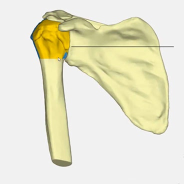 A Platform for Online 3D Planning and Ordering of 3D-Printed Shoulder Guides 