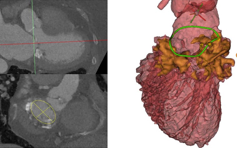 Double image, showing on the left a CT scans of the heart, and on the right, a virtual 3D model  