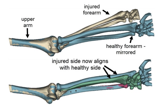 Digital comparison between the arm with an injury and a healthy arm 