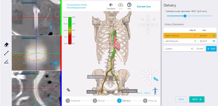 Screenshot of a patient's anatomy in Materialise Mimics Planner where the surgeon can assess the best route for a TAVR procedure