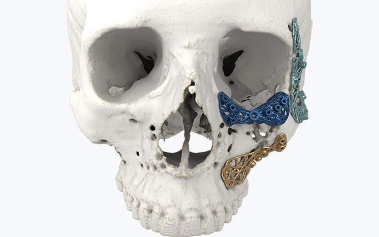 Vue de face d'un modèle de crâne avec des implants imprimés en 3D en place autour de l'œil gauche