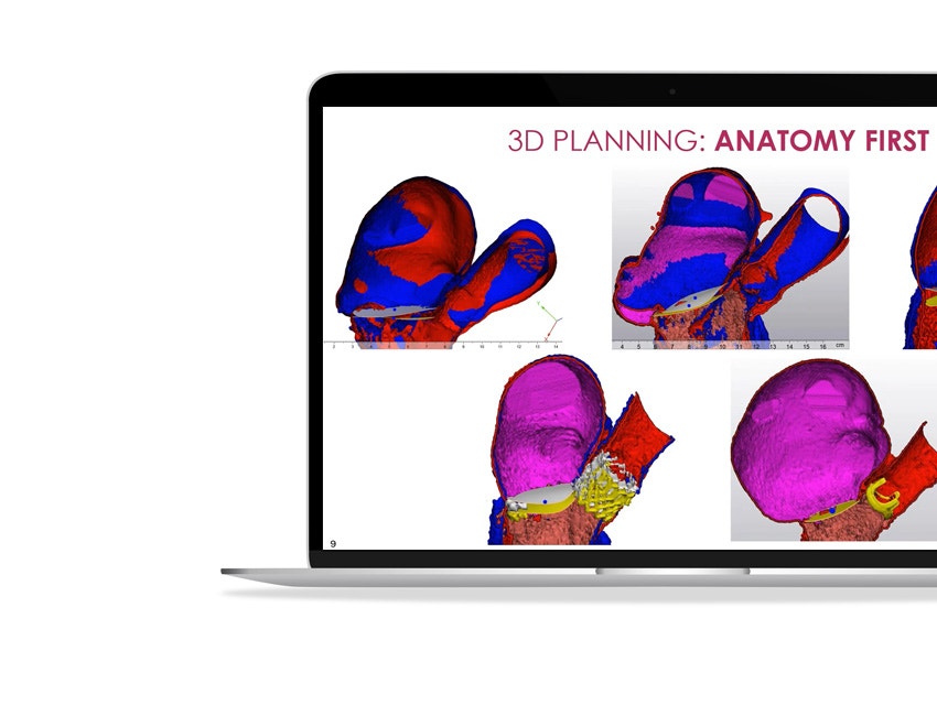 ssd-structural-heart-therapy-3d-planning-anatomy.jpg