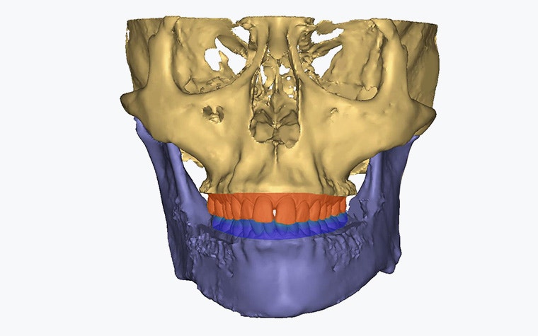 Digital image of a skull with the jaw segmented