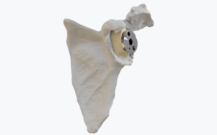 View of the metal 3D-printed Glenius shoulder implant in a shoulder model