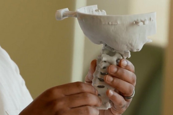 Dr. Sarkar shows the 3D-printed model of Jalanea’s spine and skull 