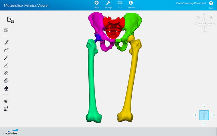 Screenshot of Materialise Mimics Viewer showing segmented hip and upper leg anatomy