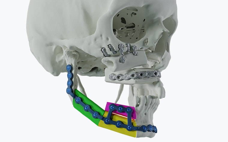 Side view of a skull with patient-matched plates along the lower jaw