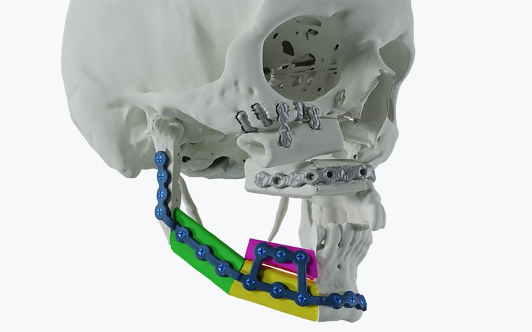 Vista lateral de un cráneo con placas adaptadas al paciente a lo largo del maxilar inferior.