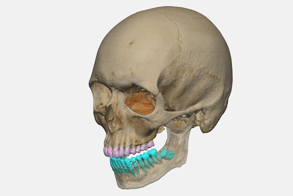 3D rendering of a human skull showing the maxillary teeth highlighted in pink and the mandibular teeth highlighted in blue.