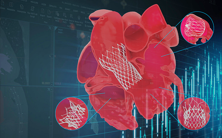 A digital illustration of a human heart with highlighted areas showing stent placements, overlaid on a background of medical interface graphics and data charts.