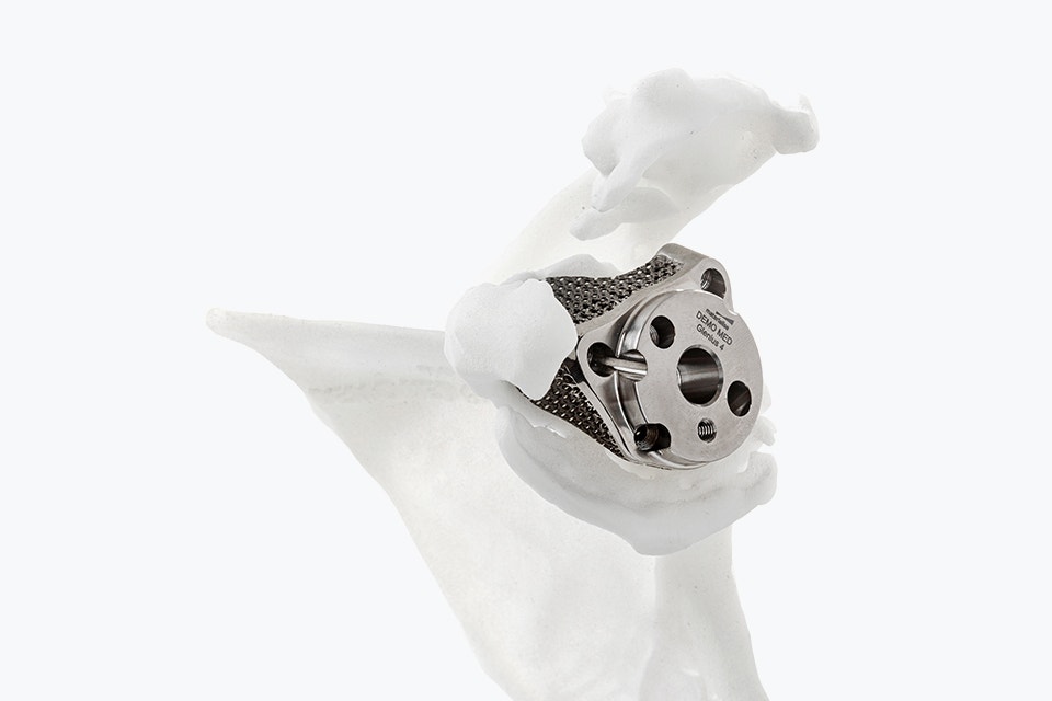 Implante de hombro Glenius impreso en 3D en un modelo de hombro