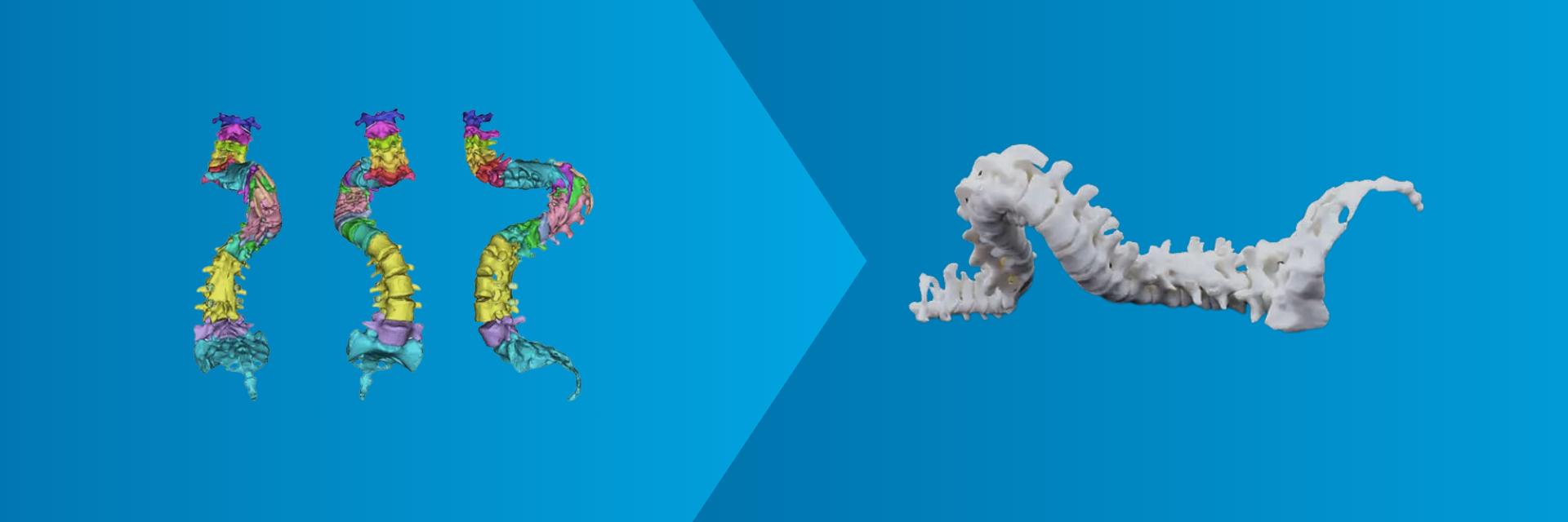 Three views of a patient's spine, segmented in medical software, with an arrow pointing towards the 3D-printed version of the spine