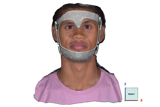 3D-printed immobilization device on a patient's face to precisely position the patient for treatment.