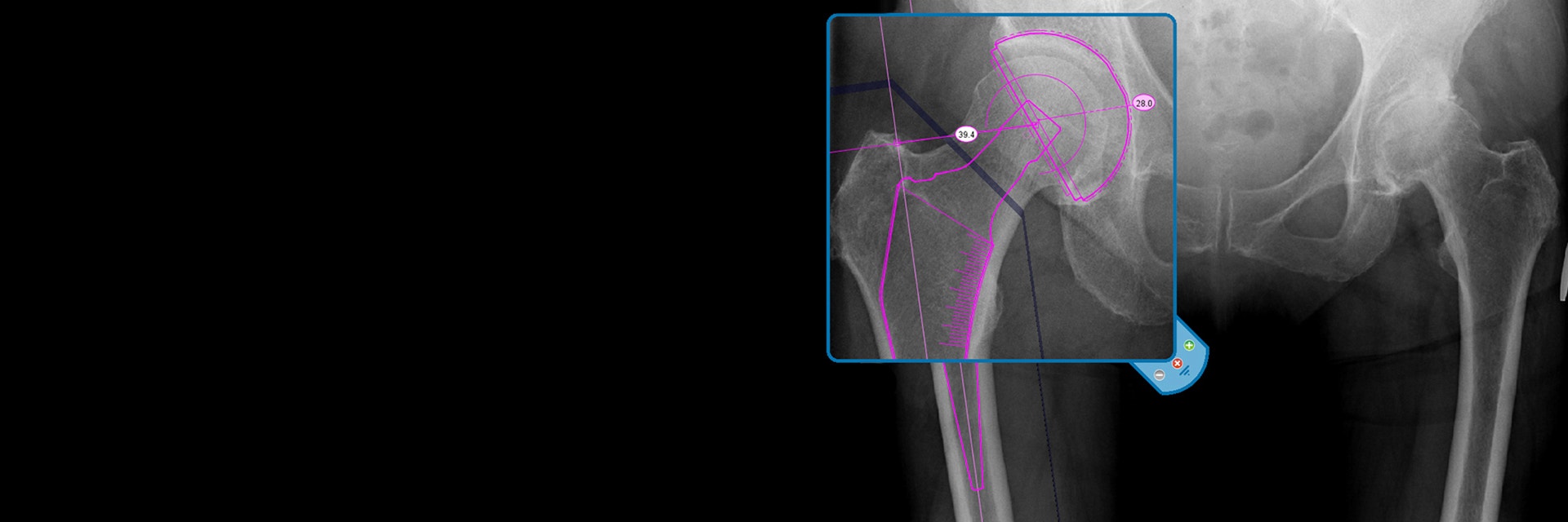 Screenshot image of hip joint templating tool on OrthoView 