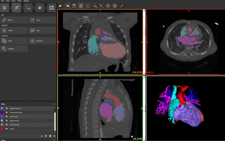 Heart segmentation tool in medical 3D printing software 
