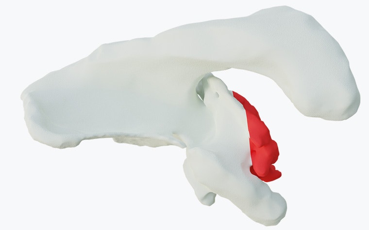 Virtual model of a shoulder bone with excessive version