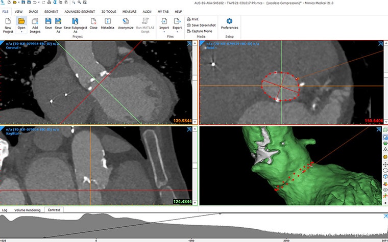 心臓の構造を測定するためにMaterialise Mimicsソフトウェアを使用している画面。