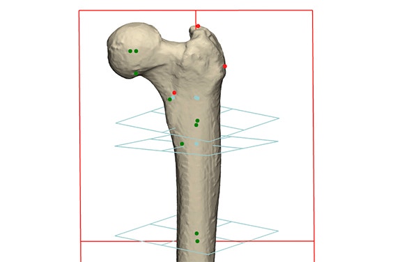 Segmenting femurs and analyzing femoral length and femoral axis 