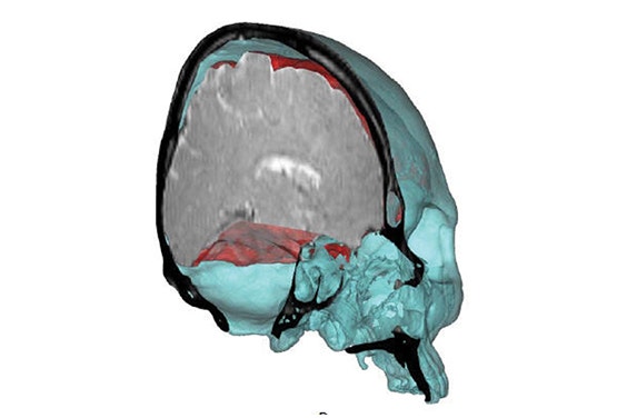 Digital segmentation of the cerebrum and skull