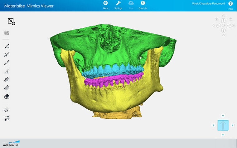 Screenshot of Materialise Mimics Viewer showing segmented skull/jaw anatomy