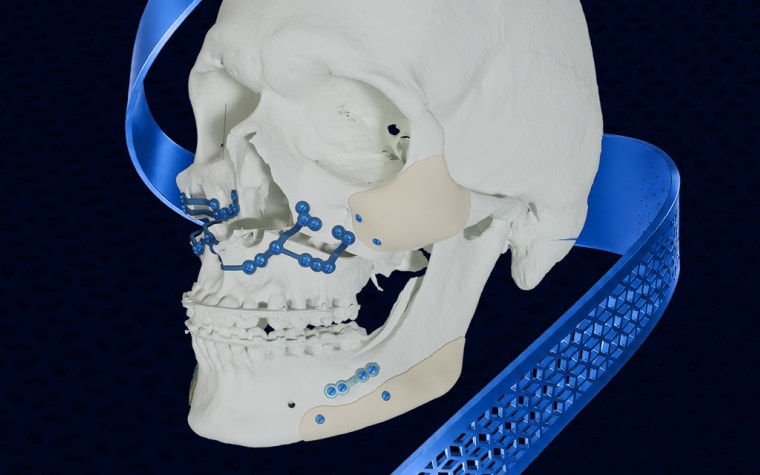 A model of a skull with 3D-printed titanium plates on a blue background.
