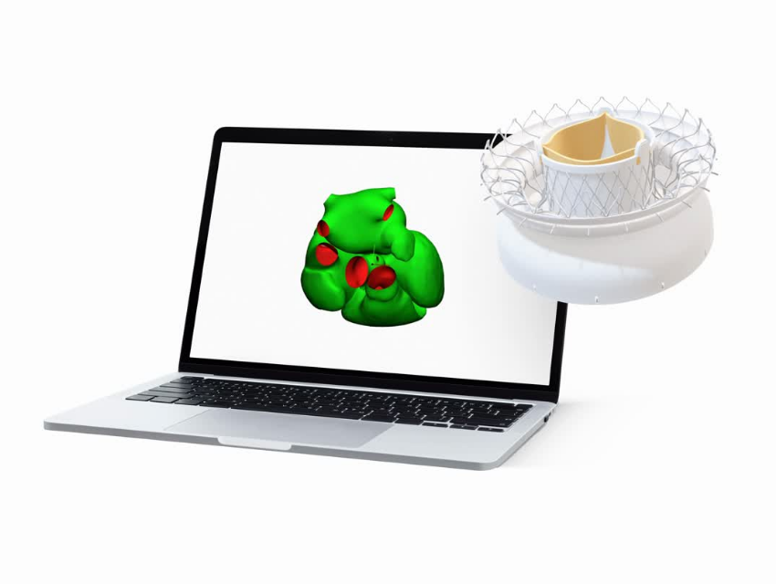 A laptop displaying a green 3D anatomical heart model with highlighted red regions beside a 3D-rendered heart valve implant on a white background.