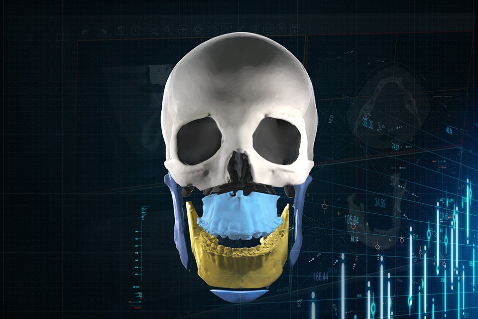ssd-mimics-englight-cmf-orthognathic-skull.jpg