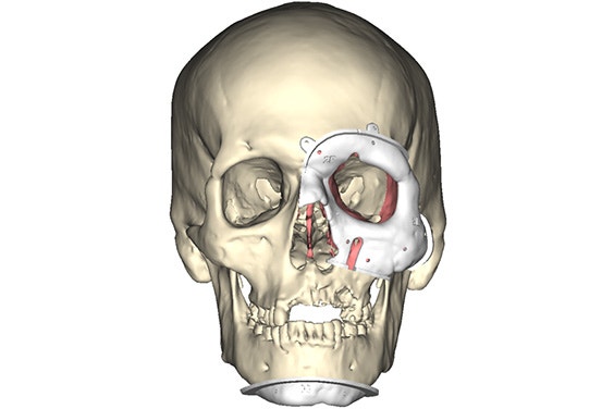 Digital image of personalized surgical guides on the recipient's skull