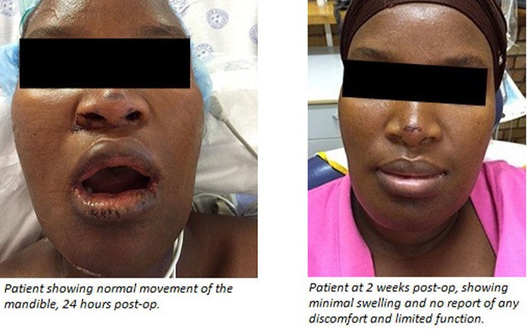 Pre- and post-op anonymized images of the patient