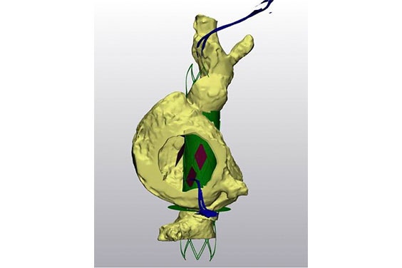 Digital planning of a valve replacement